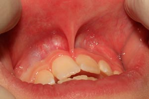 ФОТО: Короткая уздечка верхней губы у ребёнка и диастема (щель) между центральными верхними зубами.